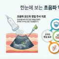 초음파 PDRN 약침